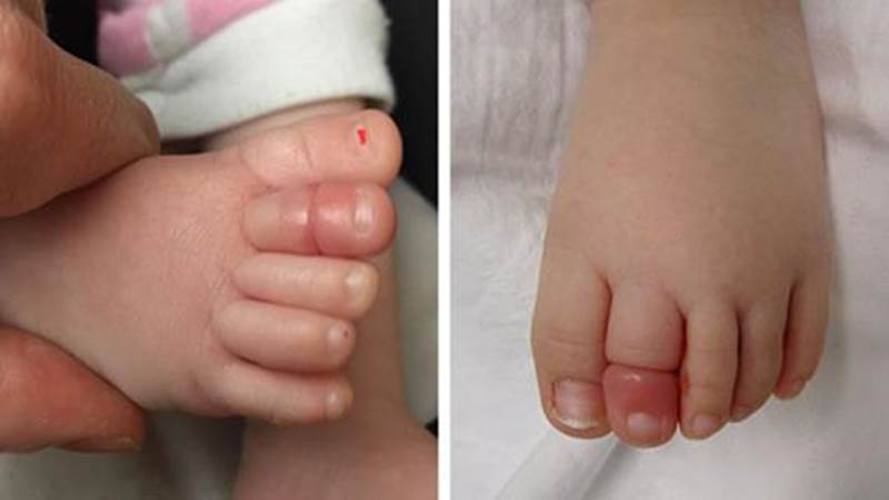 赤ちゃんが泣き叫ぶ理由がわからず両親は頭を抱えた。その原因は足の指にあった